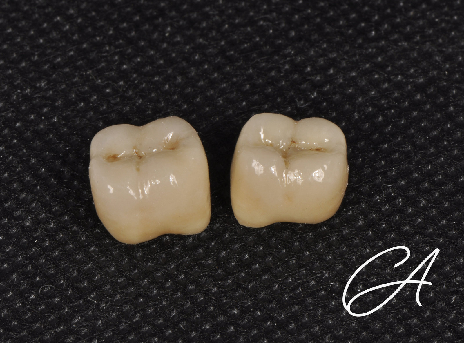 Corone in zirconia stratificata – Allungamento di corona clinica