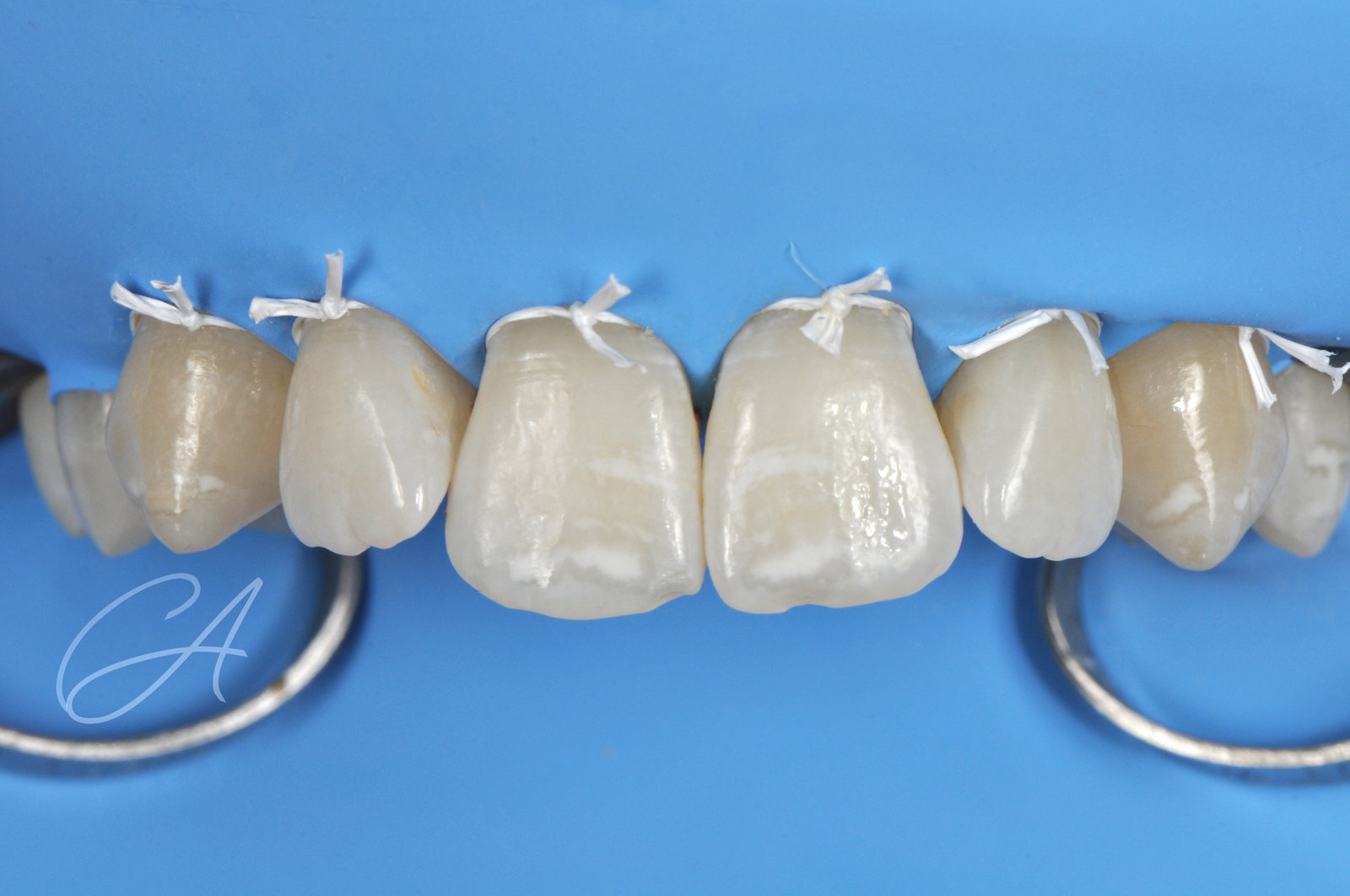 Isolamento con diga – White spot sugli incisivi, senza trapano