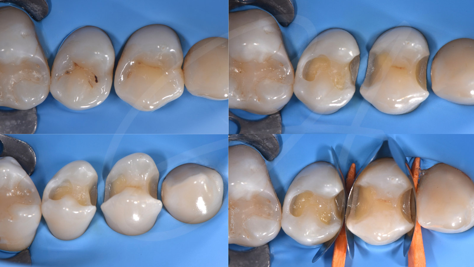 Prima – Carie e chiusura di un diastema