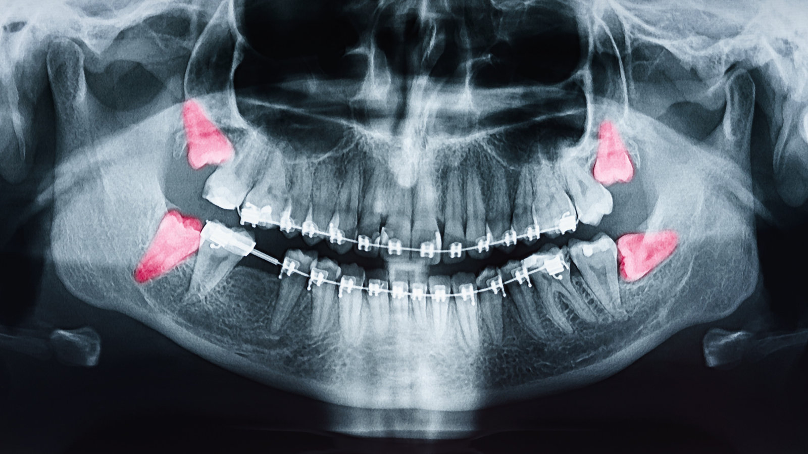 Denti del giudizio
