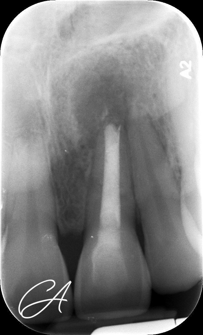 Controllo a 6 mesi – Incisivo traumatizzato: tappo apicale bioceramico