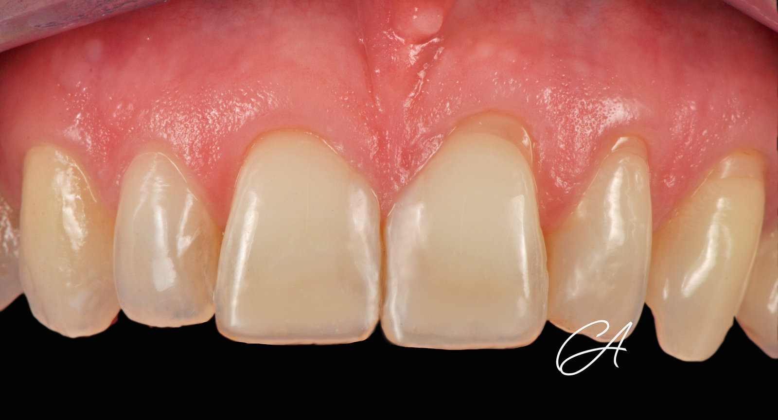 Risultato a 10 giorni – Denti frontali consumati