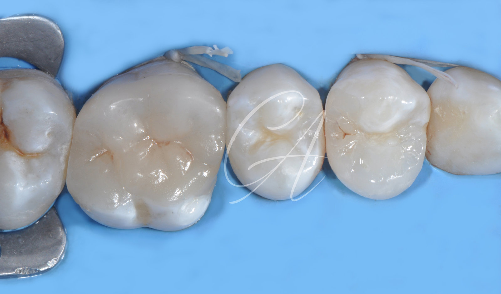 Intarsi cementati – Intarsi in disilicato e composito dopo un trauma