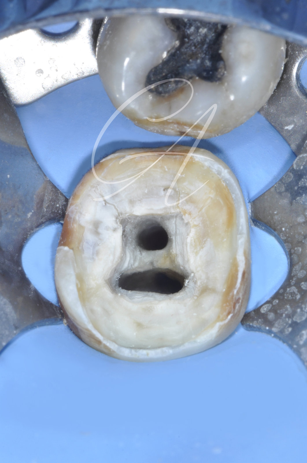 Fase intraoperatoria – Molare inferiore con anatomia complessa