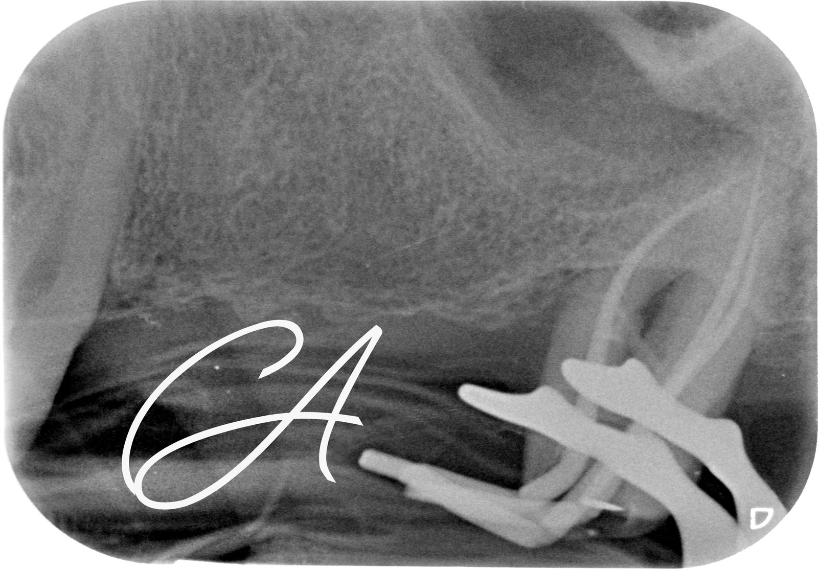Prova del cono – Salvato a 75 anni, invece di estrarlo