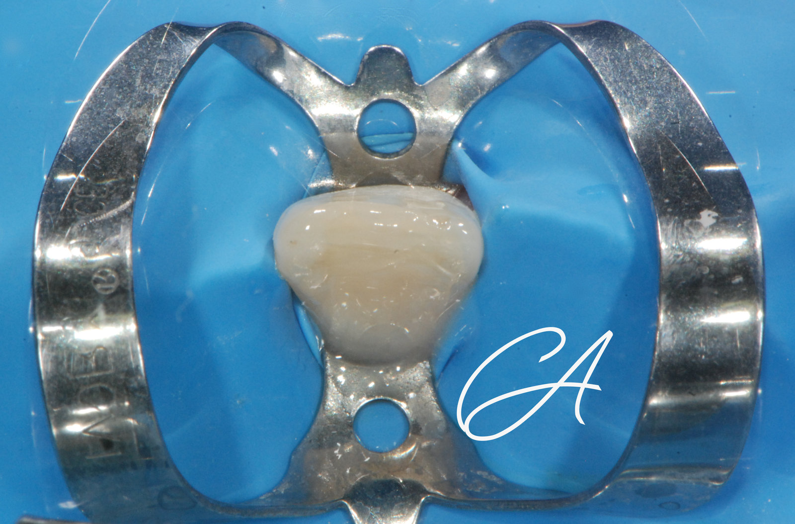 Ricostruzione finale – Incisivo traumatizzato: tappo apicale bioceramico