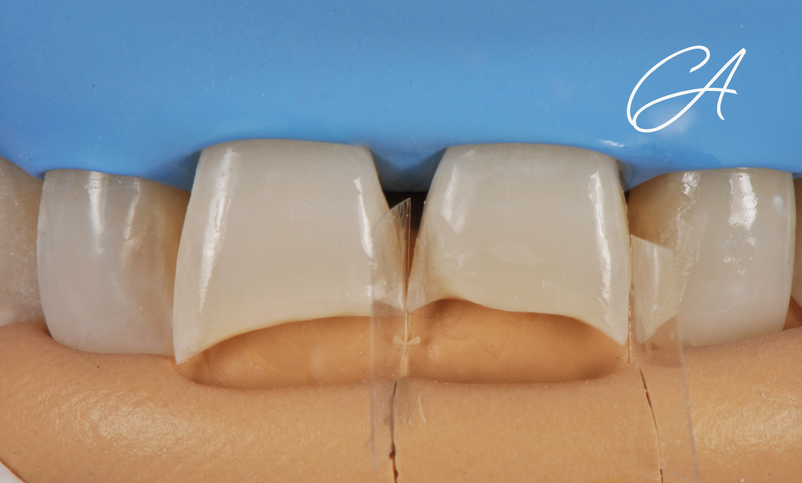 Fasi operatorie – Denti frontali consumati