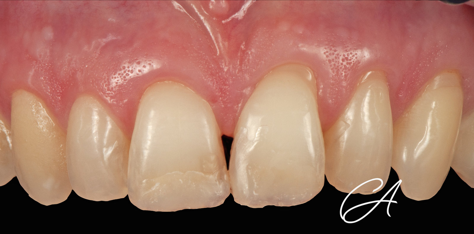 Prova della forma – Denti frontali consumati