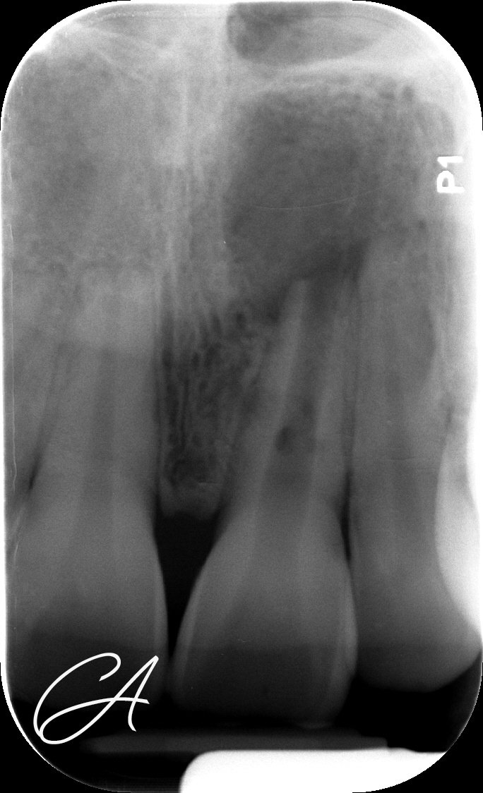 Radiografia iniziale – Incisivo traumatizzato: tappo apicale bioceramico