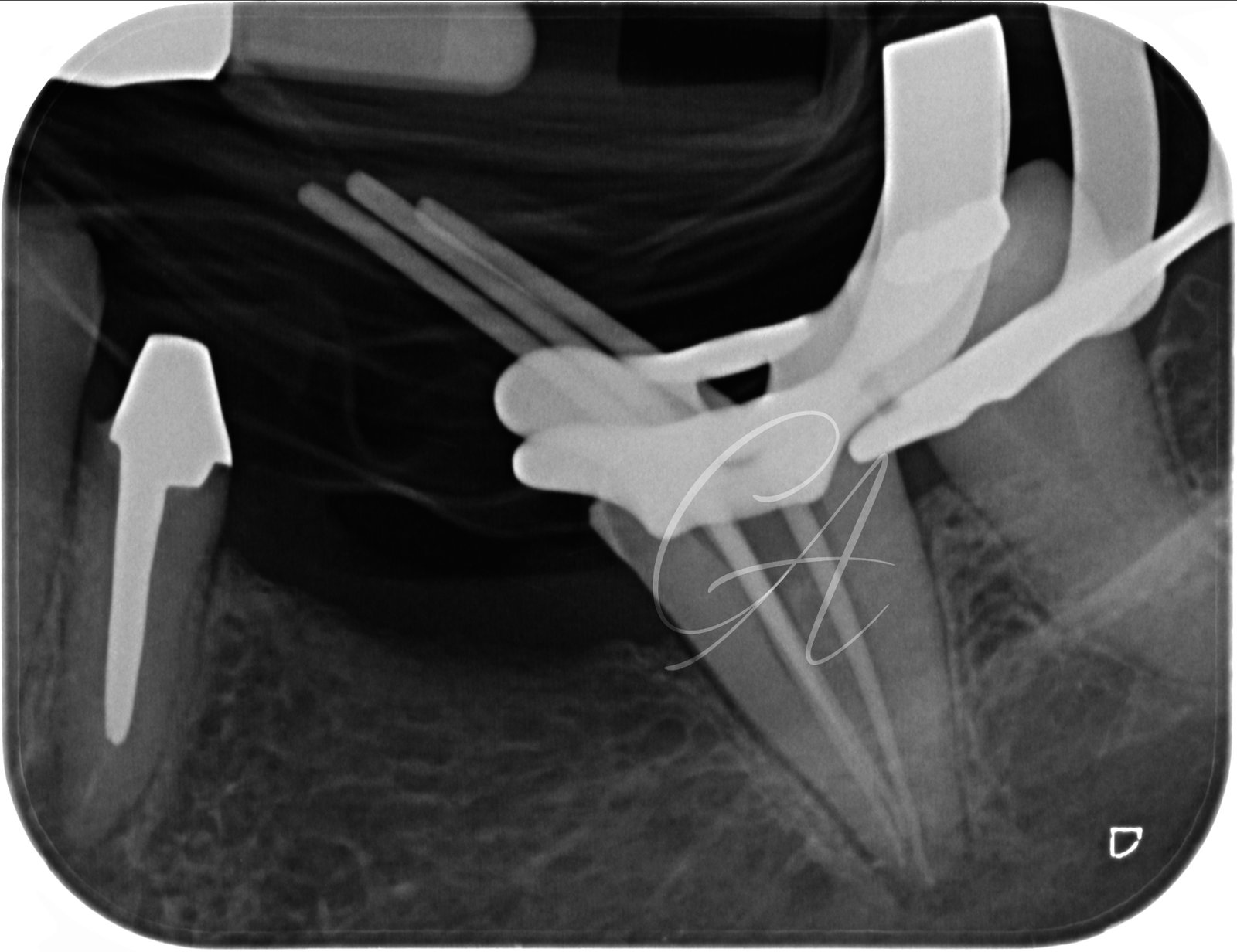 Prova del cono – Molare inferiore con anatomia complessa