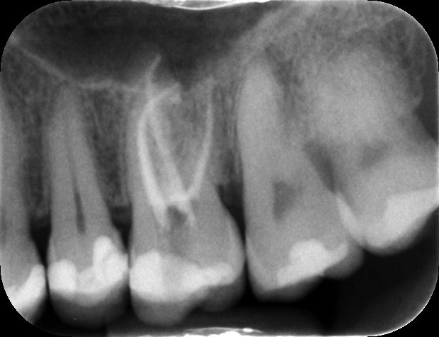 Molare superiore con lesione periapicale