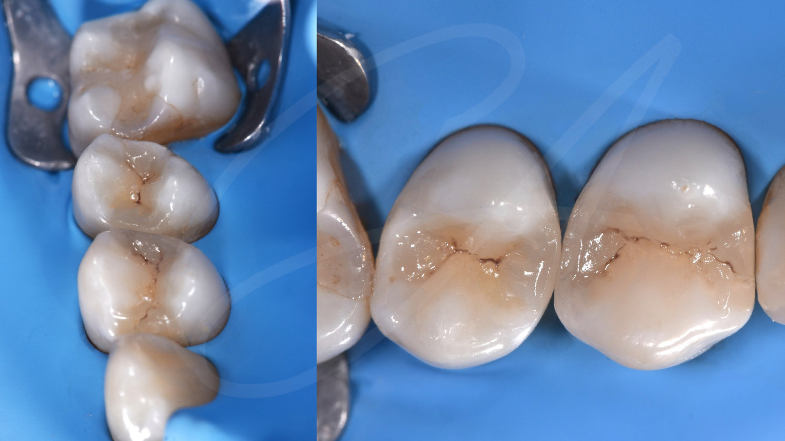 Trattamento – Carie e chiusura di un diastema