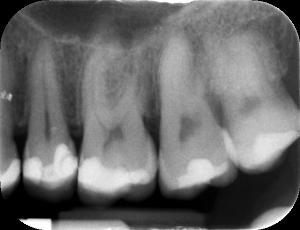 Radiografia iniziale – Molare superiore con lesione periapicale