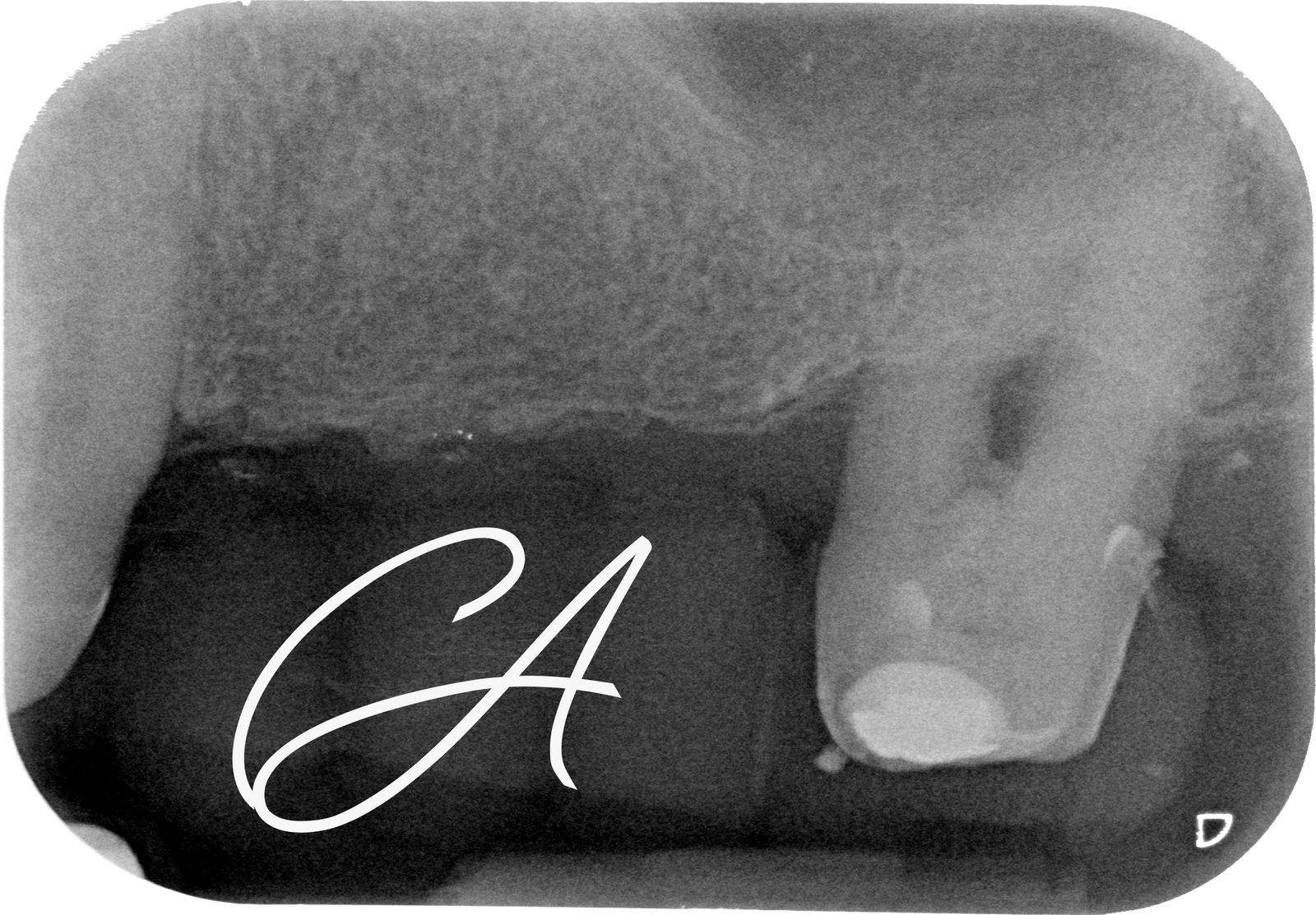 Radiografia iniziale – Salvato a 75 anni, invece di estrarlo