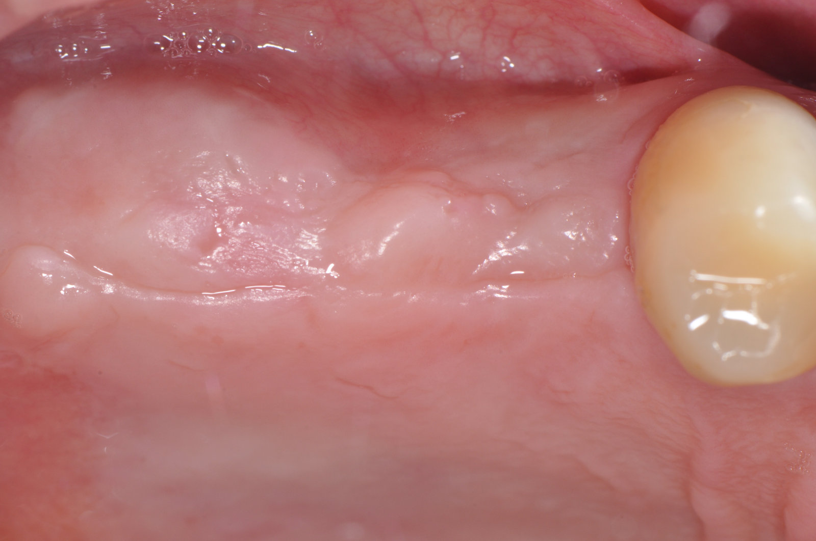 Scopertura implantare a 6 mesi – Grande rialzo del seno mascellare e 3 impianti