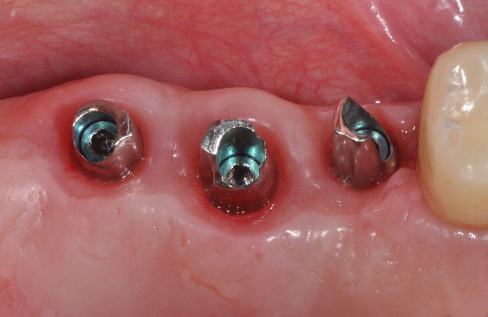 Posizionamento abutment – Grande rialzo del seno mascellare e 3 impianti