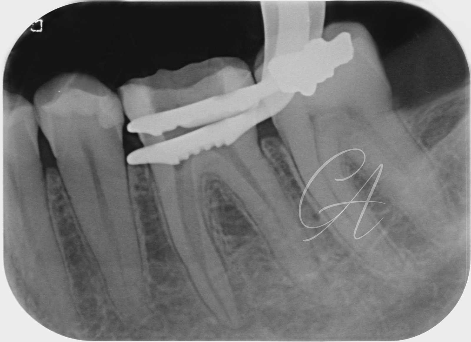 Radiografia di controllo – Rimozione di uno strumento fratturato