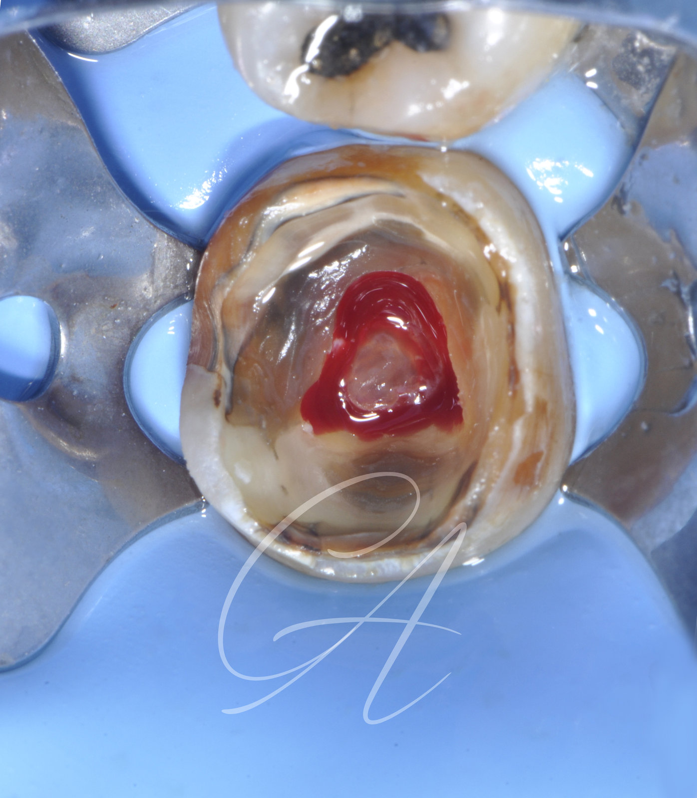 Pulpolita – Molare inferiore con anatomia complessa