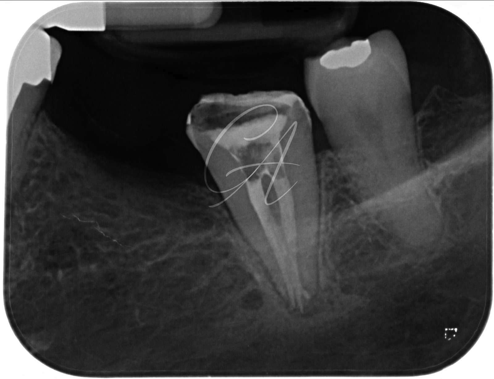 Molare inferiore con anatomia complessa