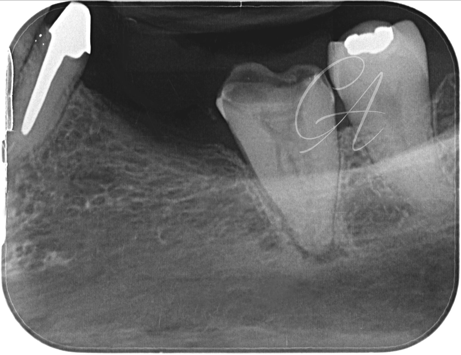 Radiografia iniziale – Molare inferiore con anatomia complessa