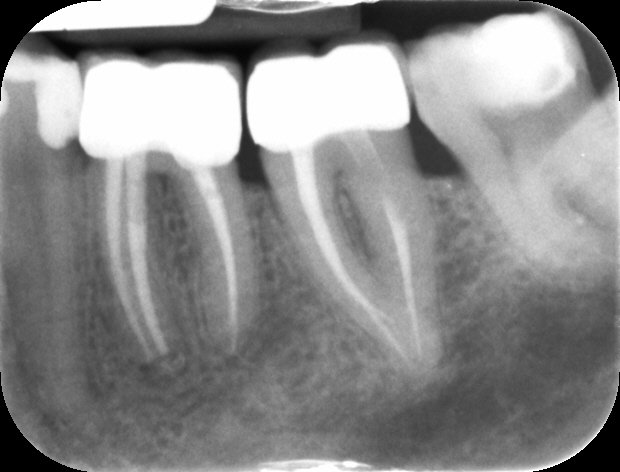 Allungamento di corona clinica