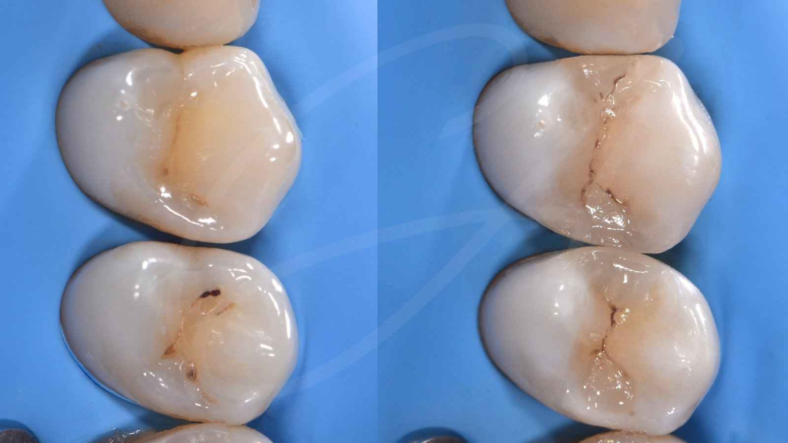 Dopo – Carie e chiusura di un diastema