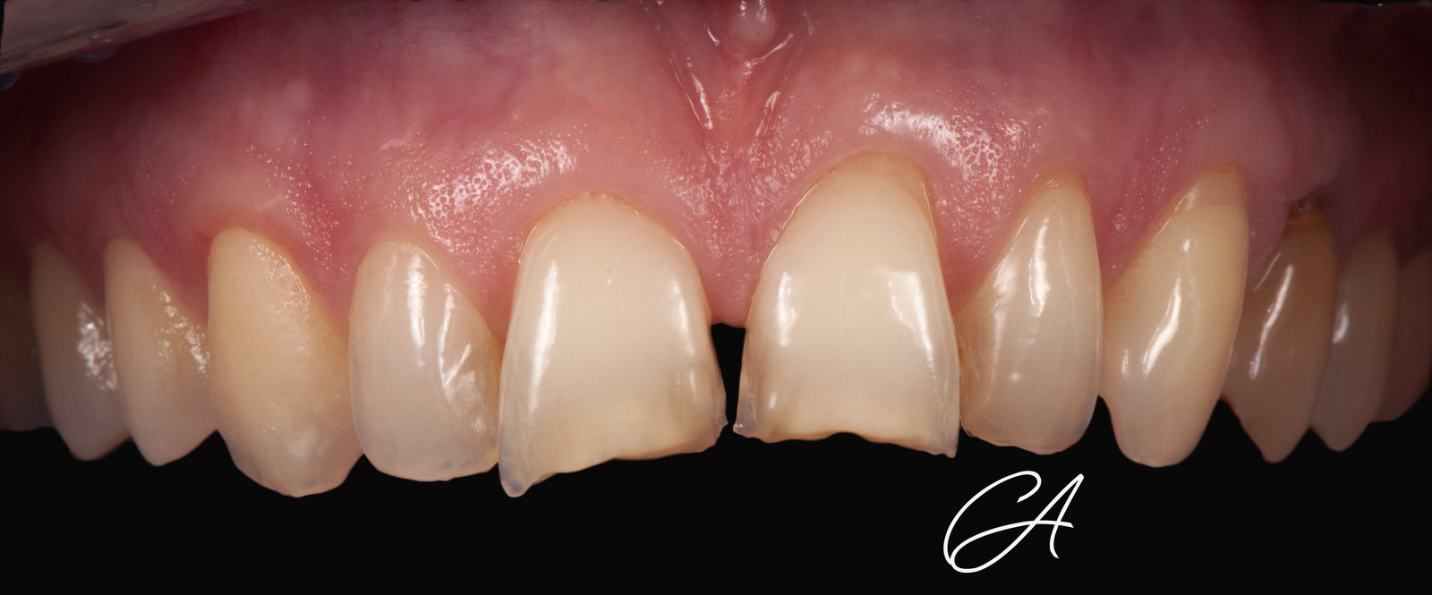 Denti consumati – Denti frontali consumati