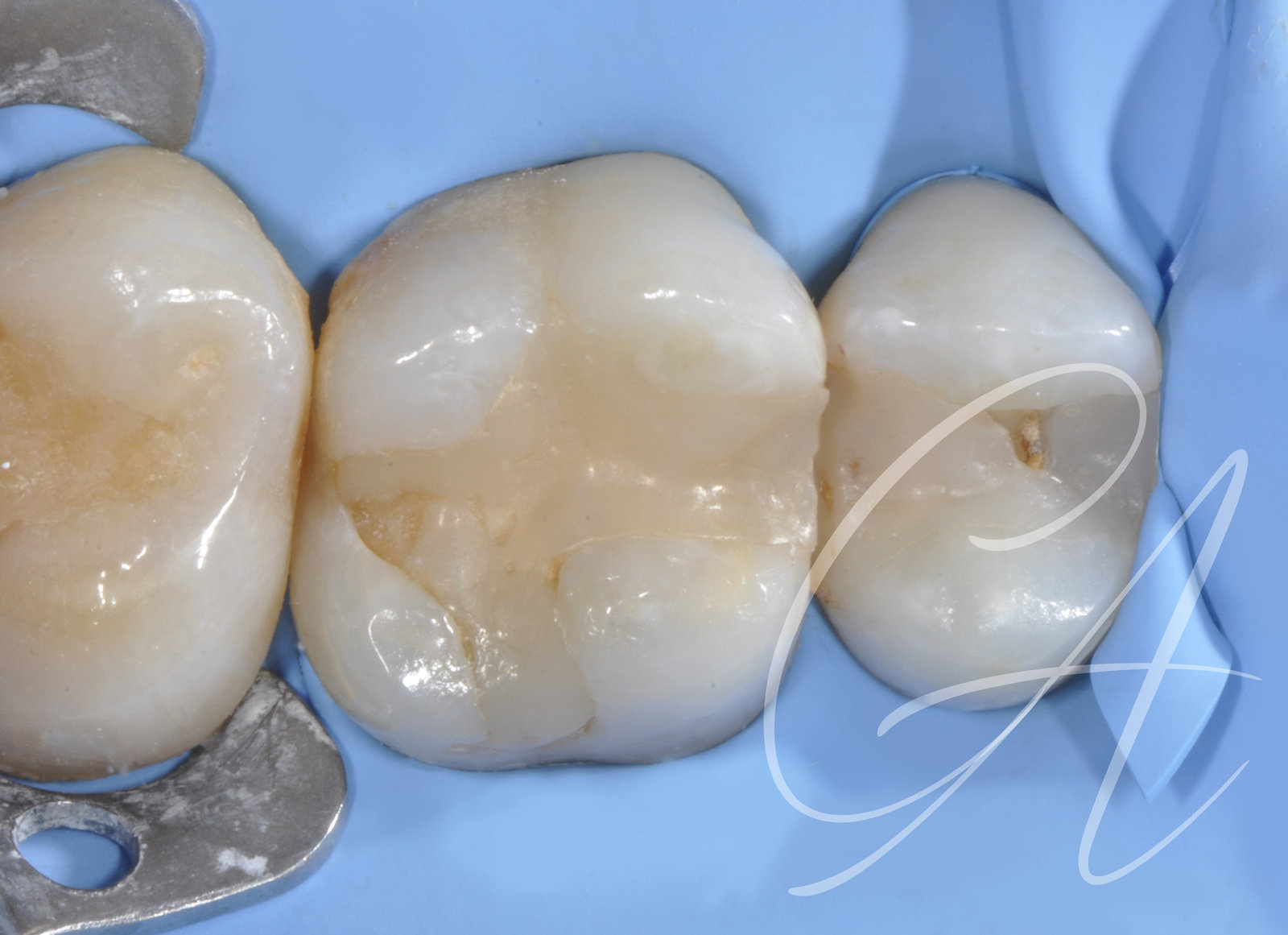 Isolamento – Molare superiore con lesione periapicale
