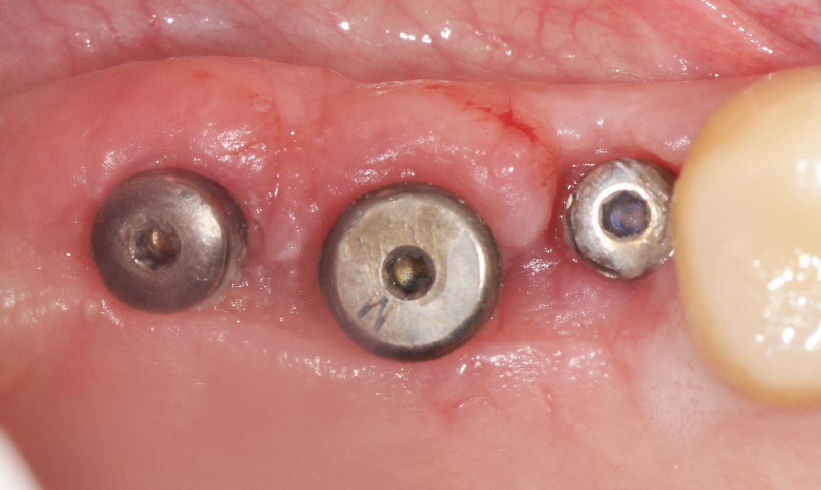 Rimozione suture a 14 giorni – Grande rialzo del seno mascellare e 3 impianti