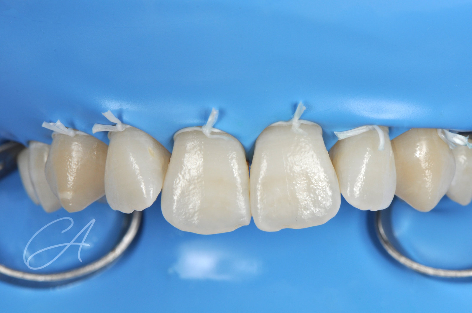 Resina ICON – White spot sugli incisivi, senza trapano
