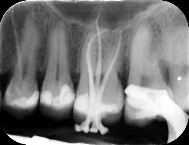 Radiografia intraoperatoria – Molare superiore con lesione periapicale