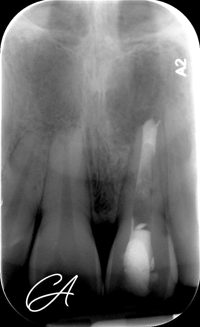 Tappo apicale bioceramico (MTA) – Incisivo traumatizzato: tappo apicale bioceramico
