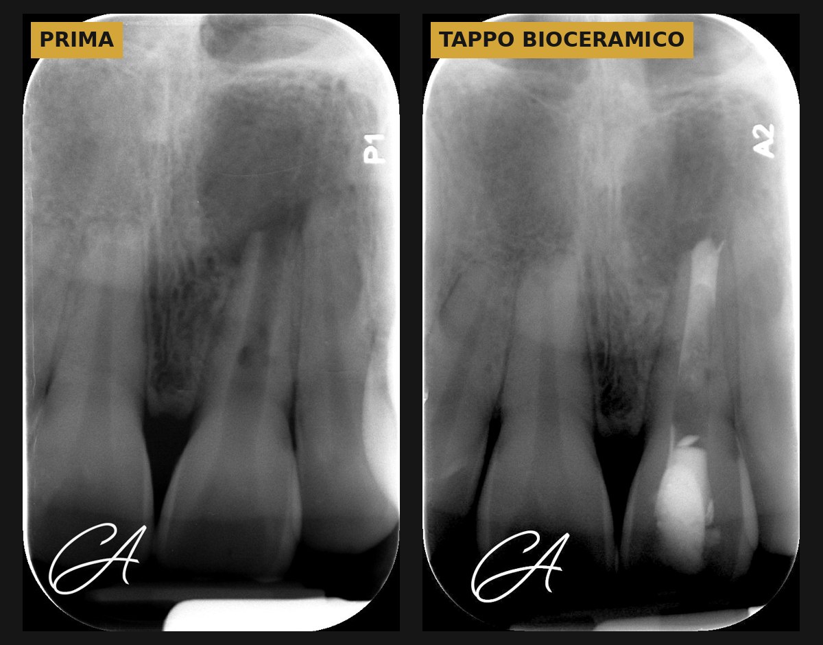 Apice aperto? Tappo apicale bioceramico